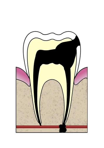 Evolución de caries