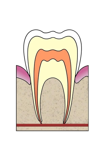 Evolución de caries