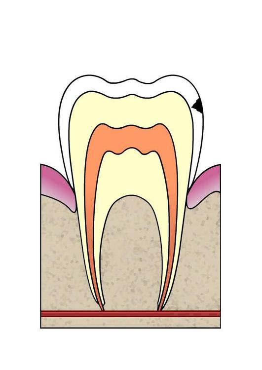 Evolución de caries