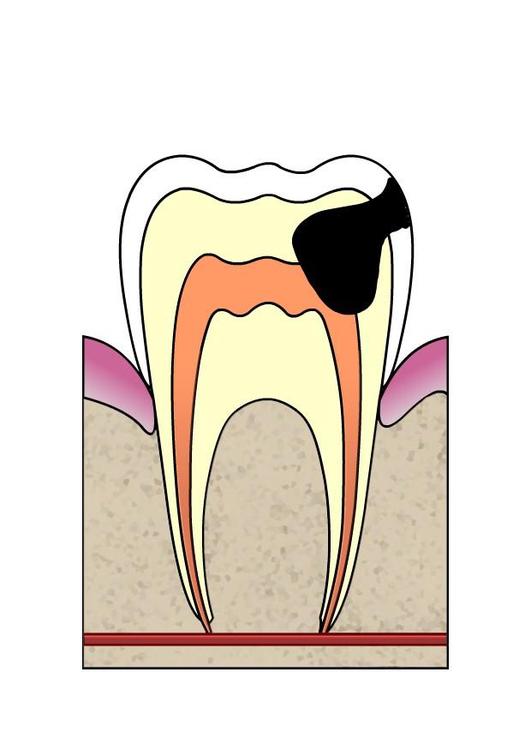 Evolución de caries