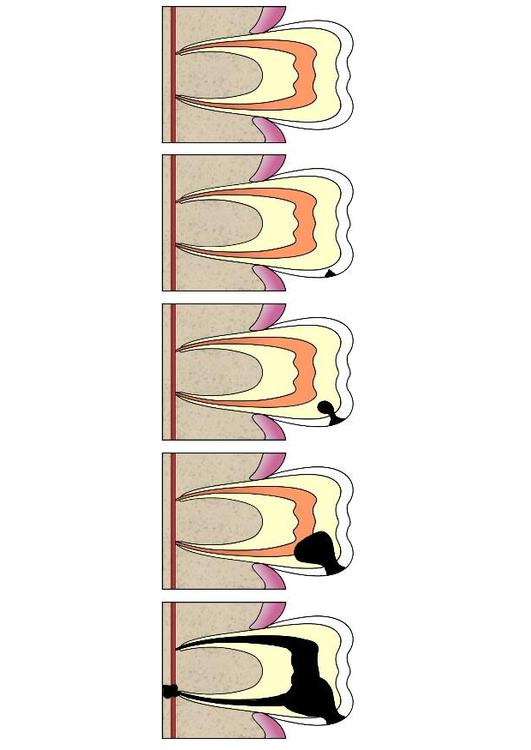 Evolución de caries