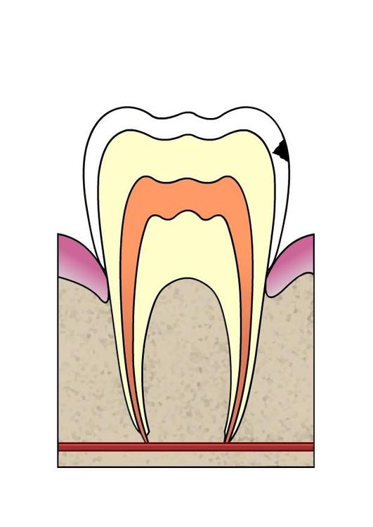 EvoluciÃ³n de caries