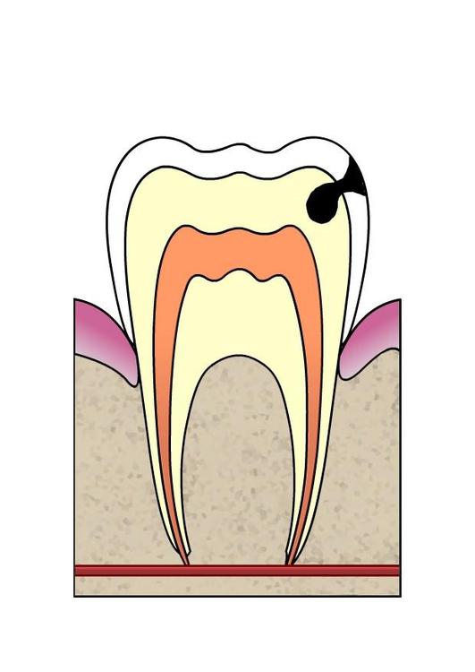 EvoluciÃ³n de caries