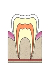 Imagen EvoluciÃ³n de caries