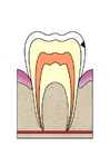 Imagen EvoluciÃ³n de caries