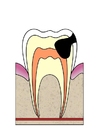 Imagen EvoluciÃ³n de caries