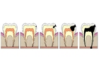 Evolución de caries