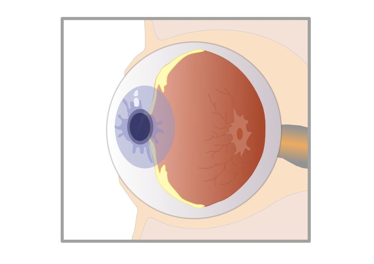 Imagen Ojo seccionado