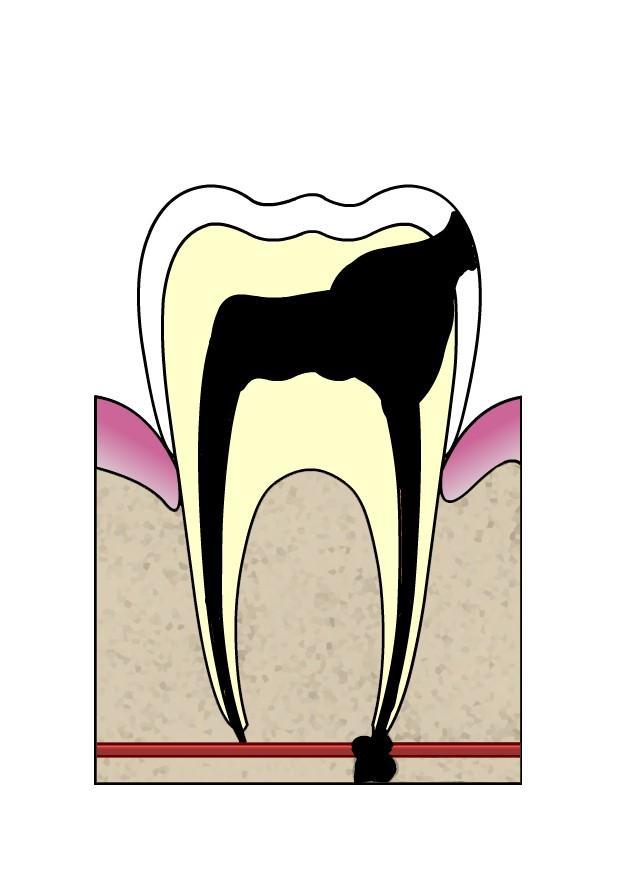 Imagen evoluciA³n de caries