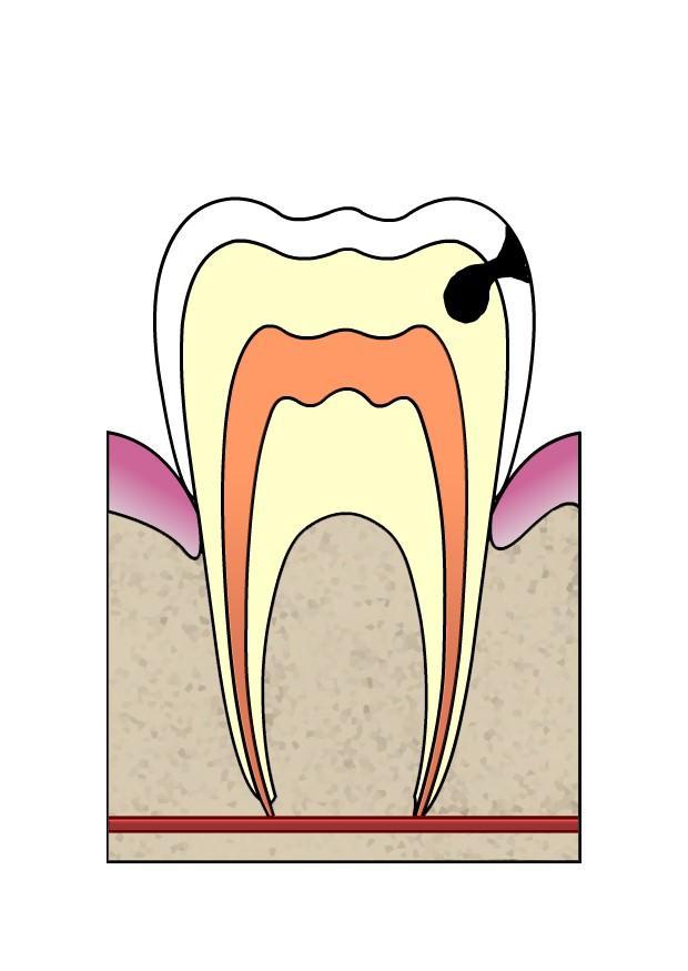 evoluciA³n de caries Imagen evoluciA³n de caries