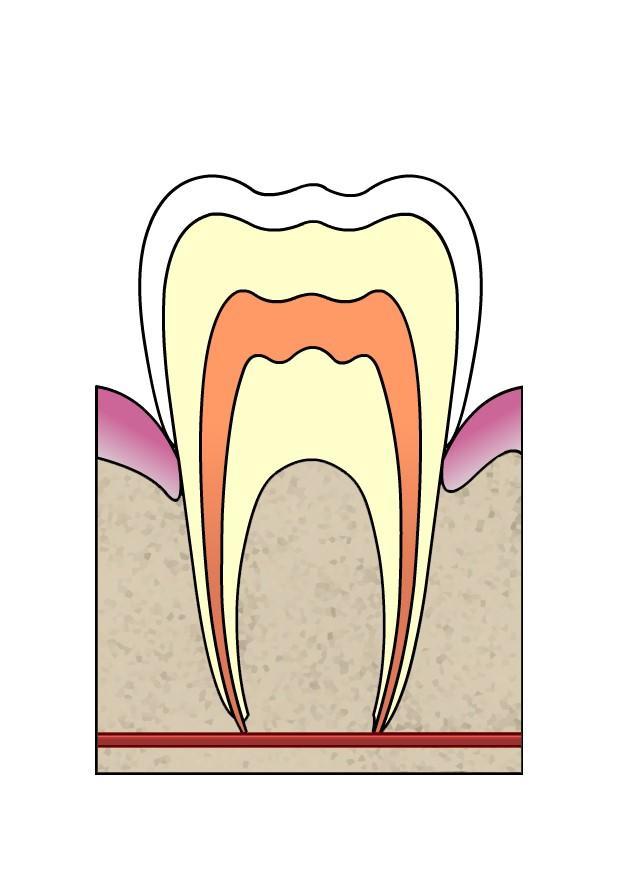 Imagen evoluciA³n de caries