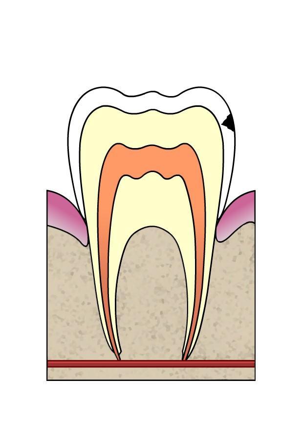 Imagen evoluciA³n de caries