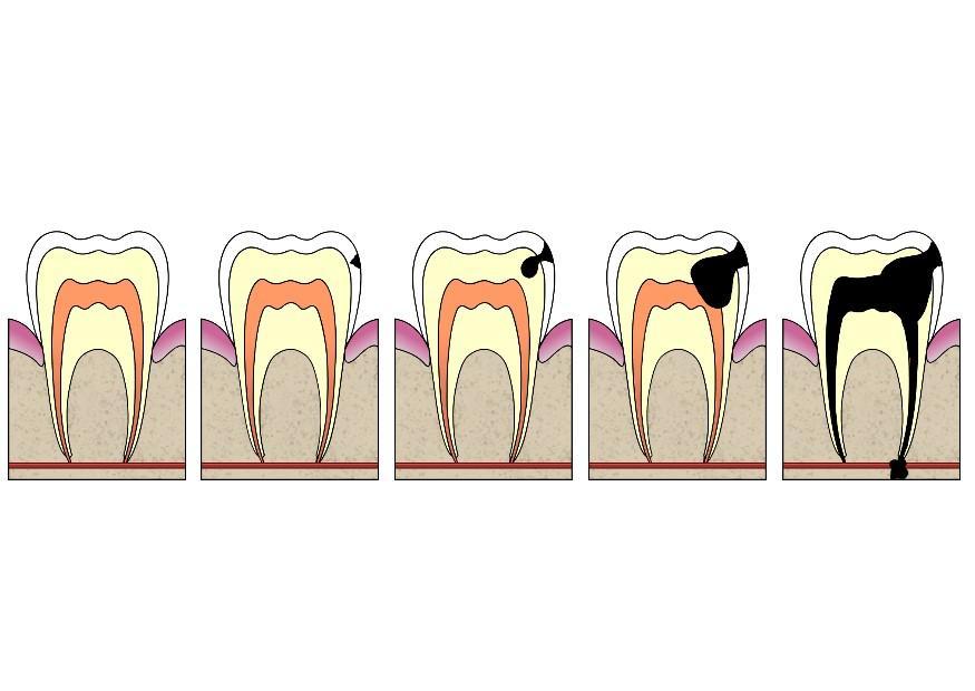 Imagen evoluciA³n de caries